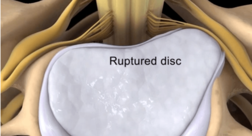 how to relieve lower back pain from herniated disc