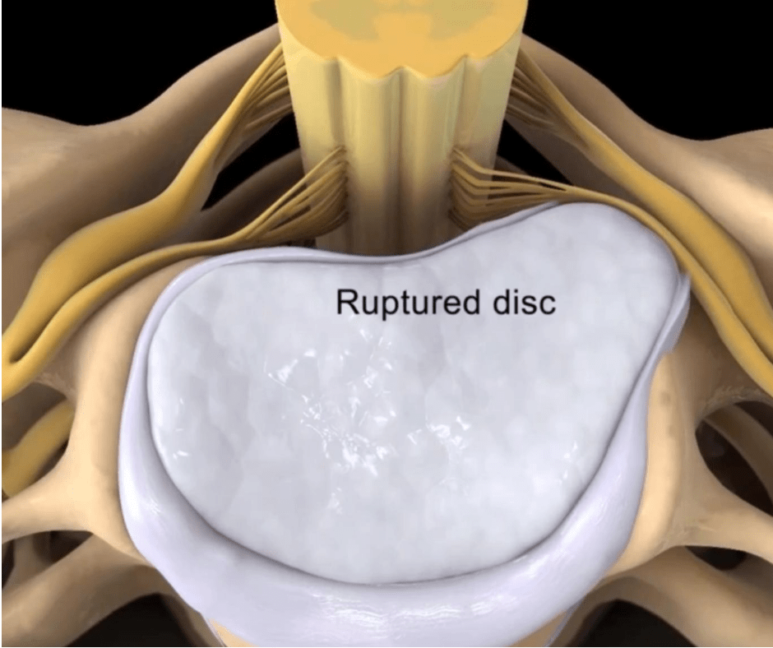 herniated-disc-treatment