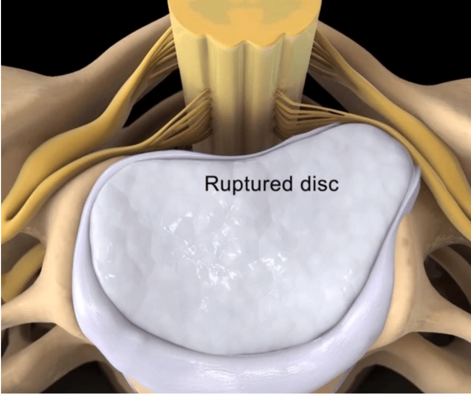 how to relieve lower back pain from herniated disc